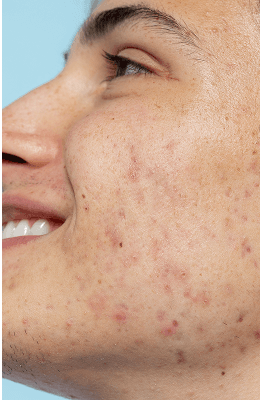 Acne Treatment