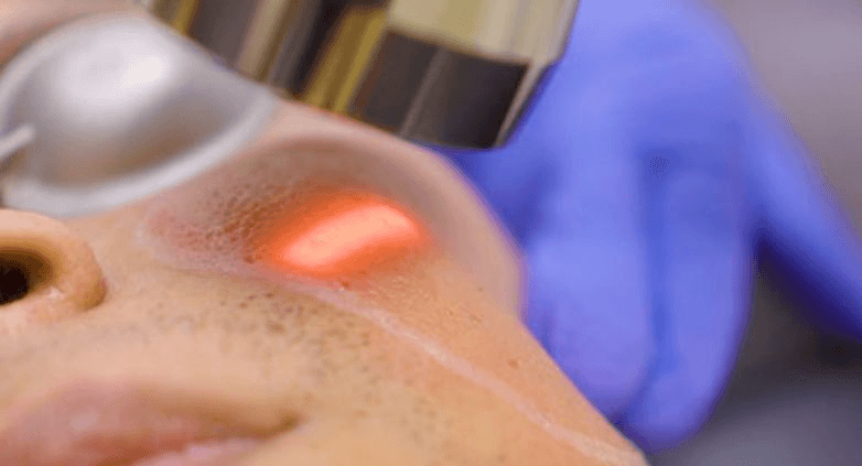 Laser Scar Surgery