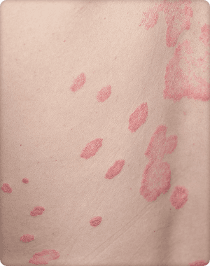 Psoriasis