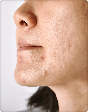 Acne Scars