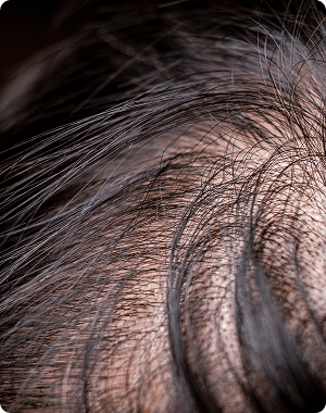 Hair Thinning